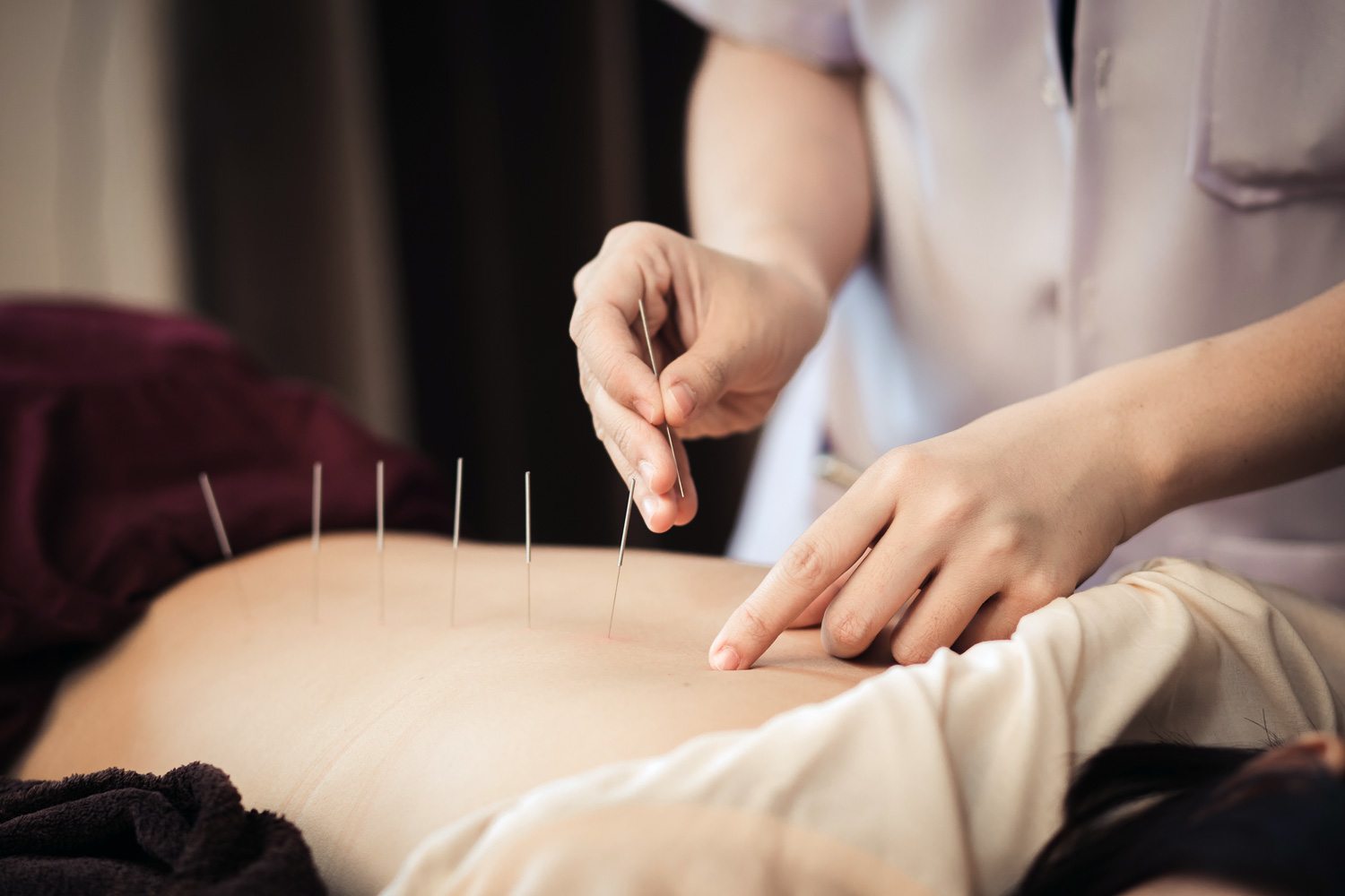 benefits-of-acupuncture-for-working-out.jpg